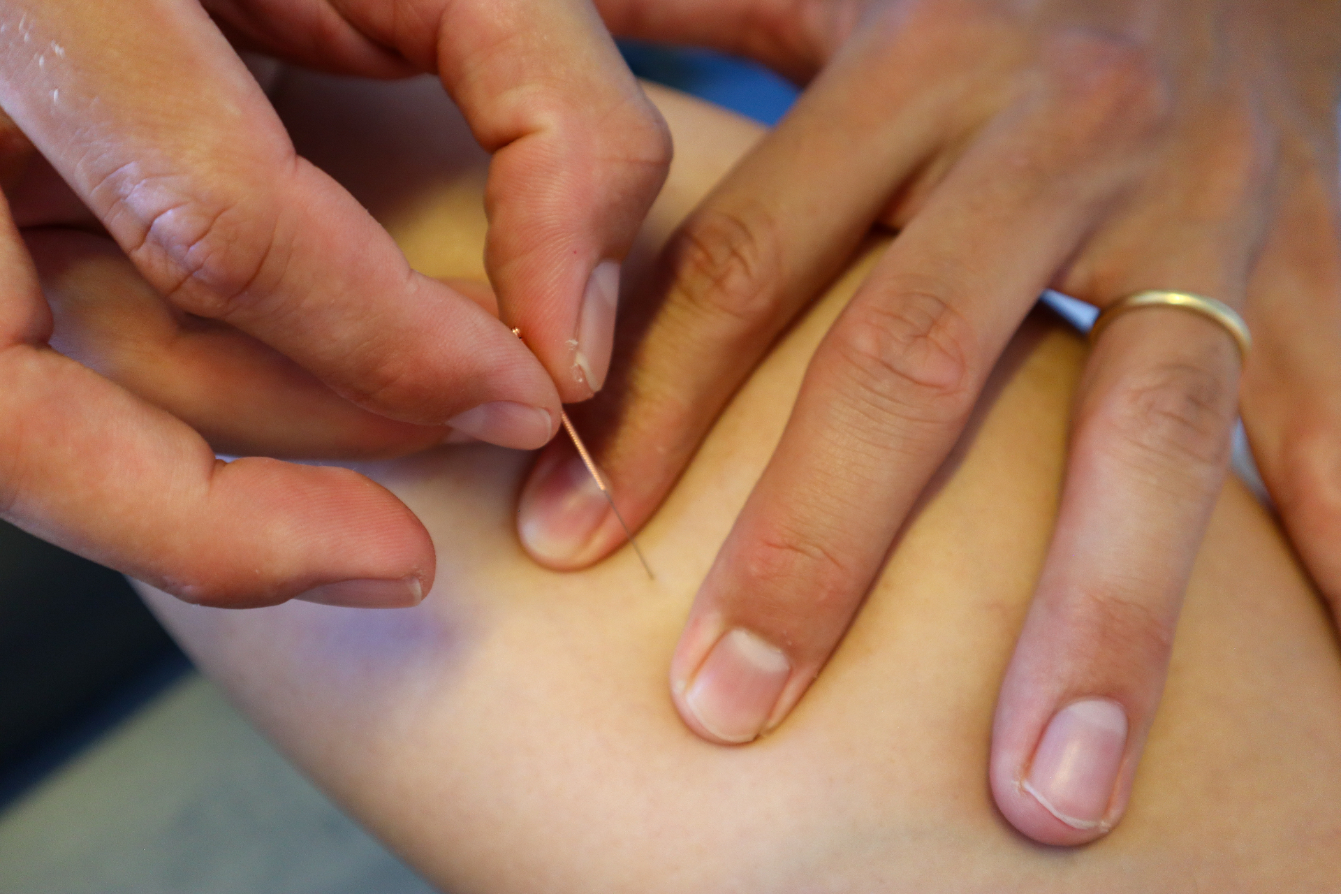 Dry Needling